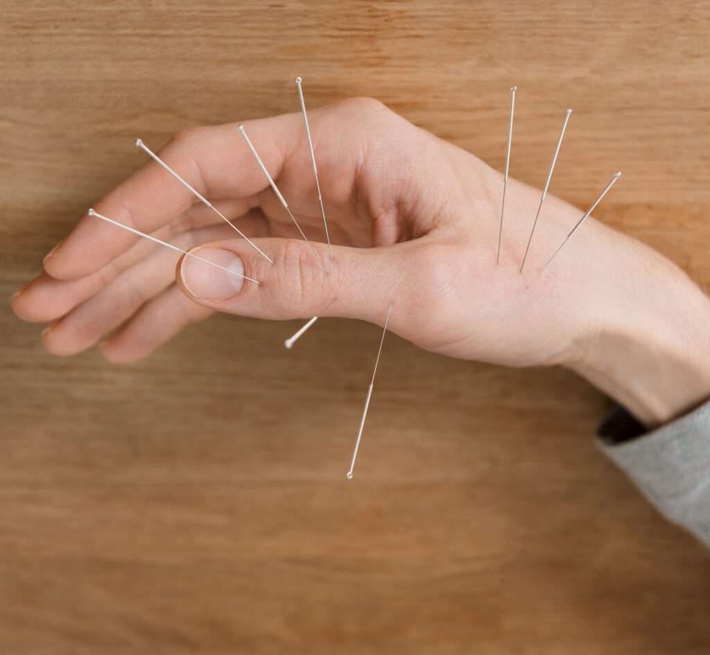 Acupuncture Sherwood Park