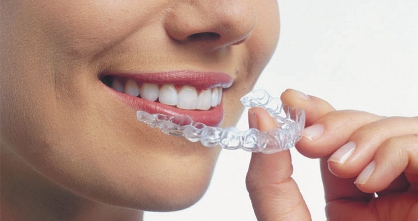 Invisalign