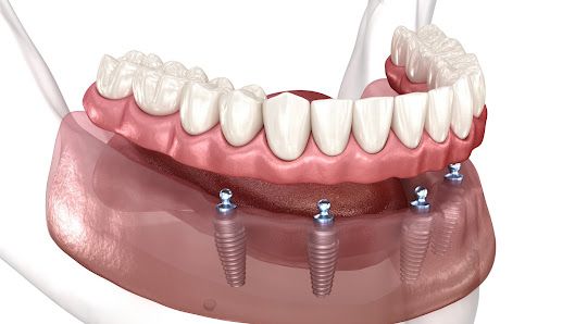 Clinique de Denturologie Linda My Linh Hua